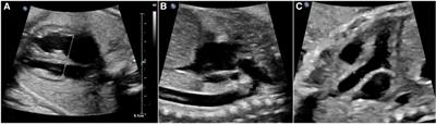 A cohort study to investigate the potential indicators for prenatal echocardiographic detection of suspected coarctation of the aorta